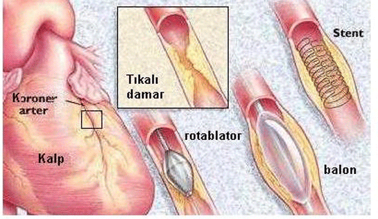 Anjiyo Nedir