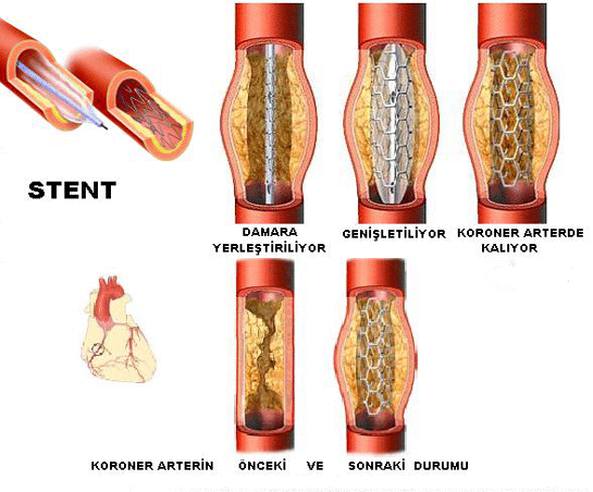 Anjiyo Stent