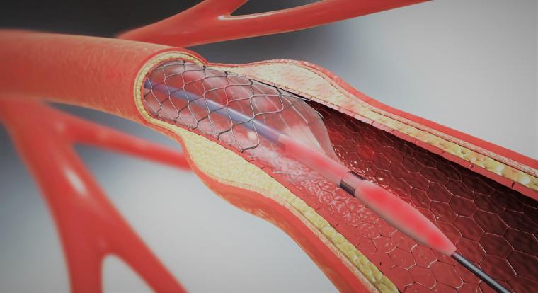 Anjiyoya Nasıl Karar Verilir?